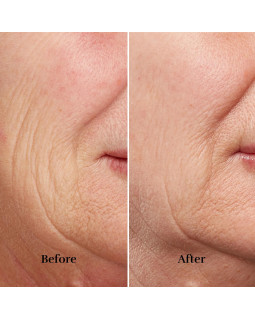 Silkn FaceTite Revive FTC1PE1001-foto5