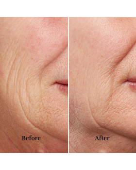 Silkn FaceTite Revive FTC1PE1001-foto5