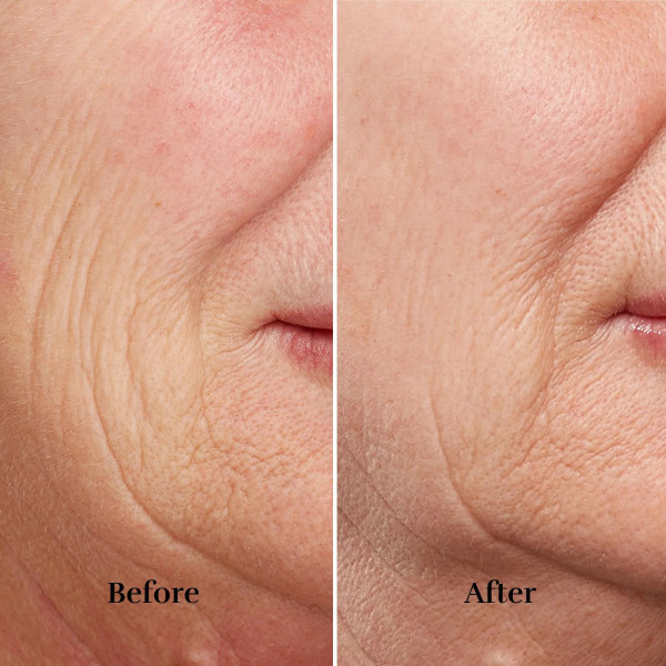 Silkn FaceTite Revive FTC1PE1001